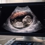Identifier le placenta sur une échographie de grossesse : guide pratique